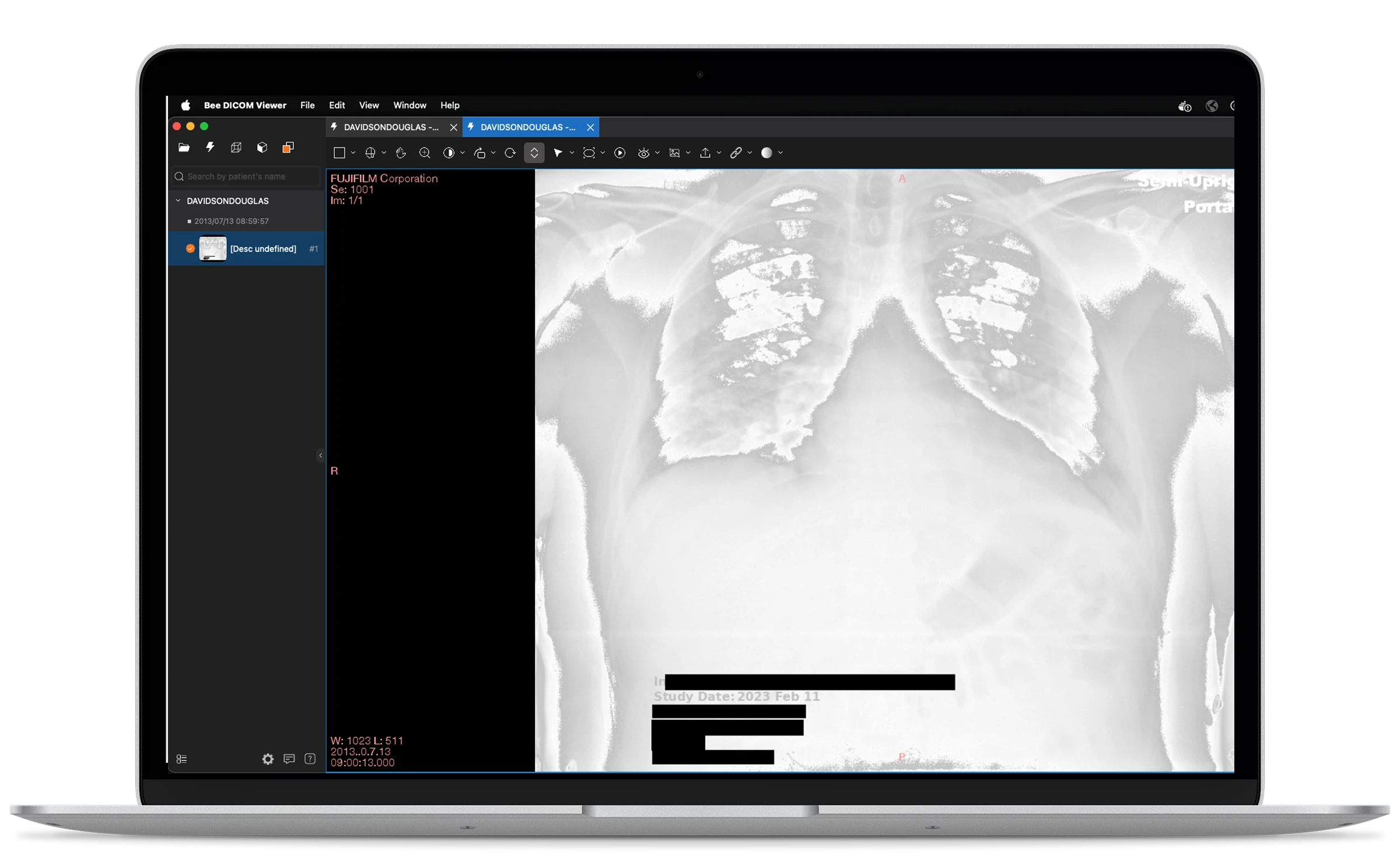 Bee DICOM Viewer — PHI burned into pixel data, flagged for redaction